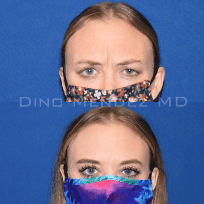 pinnacleskin.com /treatments/botox Carousel 1 Image 3