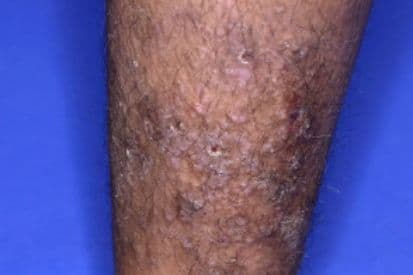 Pruritus-example