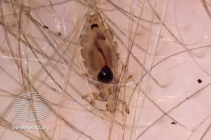 head-lice-example