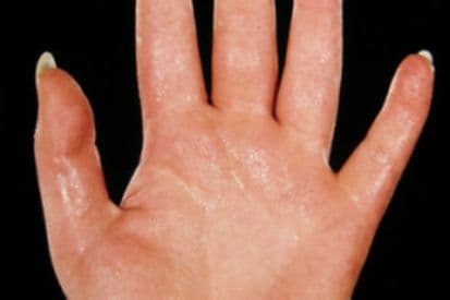 Hyperhidrosis-on-hand