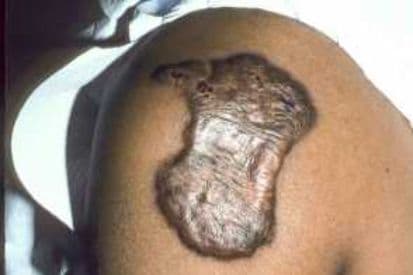 pinnacleskin.com /conditions/keloids Carousel 1 Image 1
