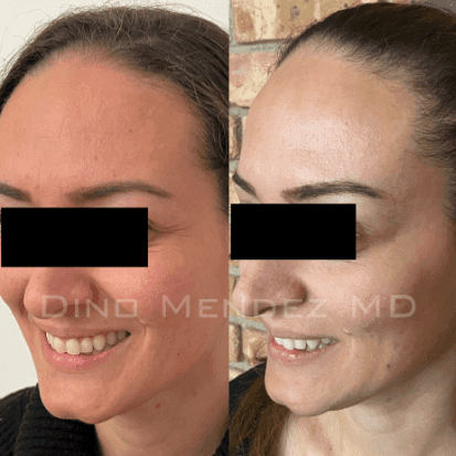 pinnacleskin.com /treatments/botox Carousel 1 Image 6