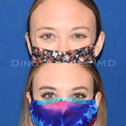 pinnacleskin.com /treatments/botox Carousel 1 Image 1