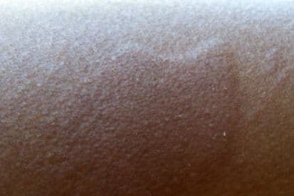 example-of-hives