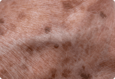 pinnacleskin.com /conditions/age-spots Carousel 1 Image 3
