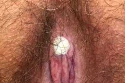 pinnacleskin.com /conditions/genital-warts Carousel 1 Image 1