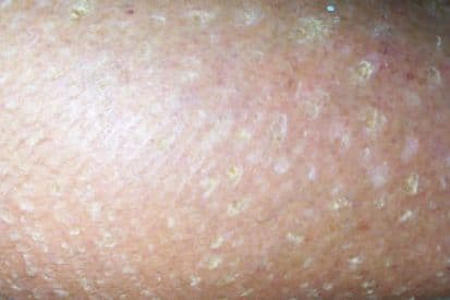 Dry-skin-example