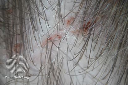 lice-in-hair