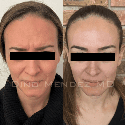 pinnacleskin.com /treatments/botox Carousel 1 Image 5