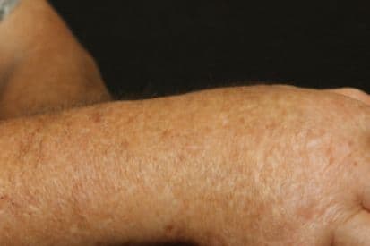 pinnacleskin.com /conditions/scleroderma Carousel 1 Image 1