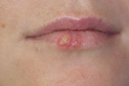 pinnacleskin.com /conditions/herpes Carousel 1 Image 1