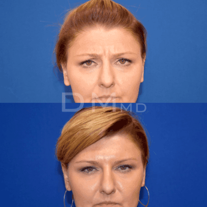 pinnacleskin.com /treatments/botox Carousel 1 Image 7