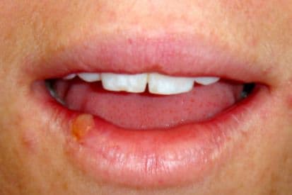 pinnacleskin.com /conditions/herpes Carousel 1 Image 3