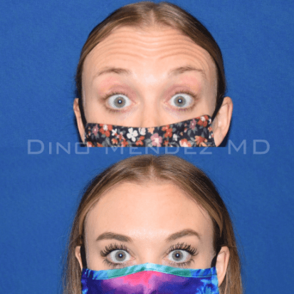 pinnacleskin.com /treatments/botox Carousel 1 Image 2