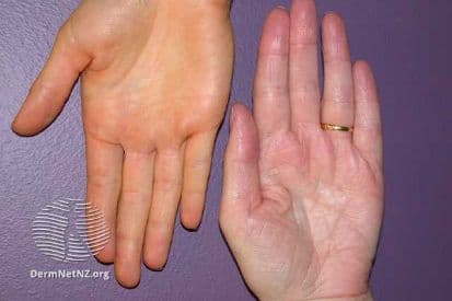 example-of-skin-discoloration-on-hands