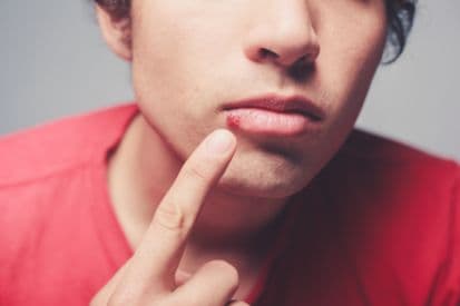 cold-sore-example