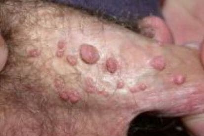 pinnacleskin.com /conditions/genital-warts Carousel 1 Image 2