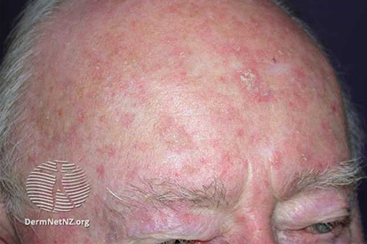 actinic-keratosis-4