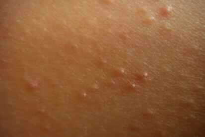 Keratosis-pilaris1