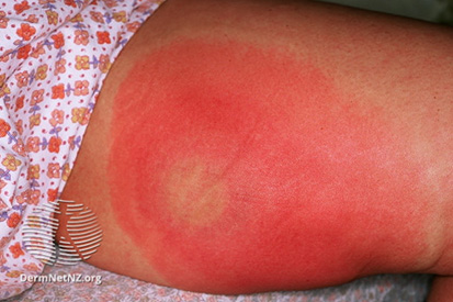 cellulitis-5