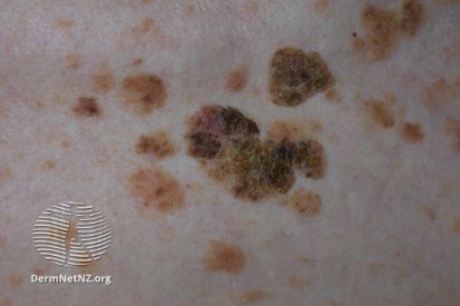 Seborrheic-Keratosis2