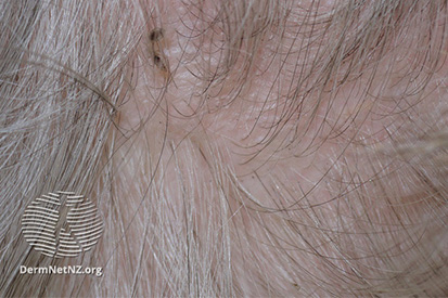 HeadLice4