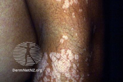 Tinea-Versicolor3